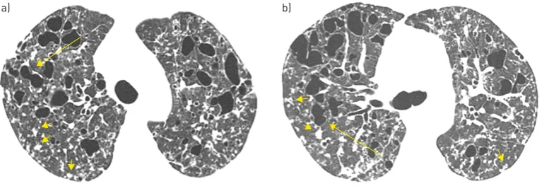 FIGURE 2 A 27-year-old man with pulmonary Langerhans cell histiocytosis. High-resolution computedtomography scans of a) upper and b) middle lung regions show multiple thin-walled cysts, some withirregular shapes (arrows), in both lungs