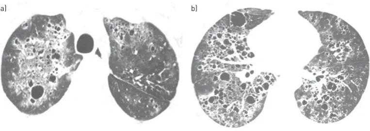 FIGURE 5 A 37-year-old man withscans of Pneumocystis jiroveci pneumonia. High-resolution computed tomography a) upper and b) lower lobes demonstrate thin-walled cysts associated with ground-glass opacitiesdistributed throughout both lungs.