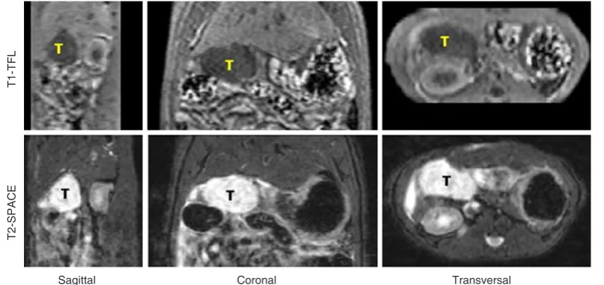 Figure 5: Volumetric measurement for pancreatic head tumor from 3D data. Upper: Fast T1-weighted TFL sequence can be finished in 80 s with 2 averages