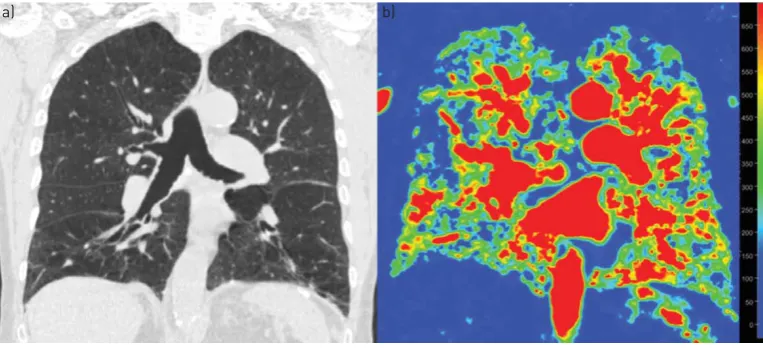 FIGURE 2 a) For segments in the middle and lower lobes centrilobular emphysema was found to be the predominanttype on computed tomography