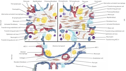 FIGURE 1 This schematic view of the morpho-functional unit of the lung (alveolus) depicts the main differences in cellular composition in idiopathicpulmonary fibrosis (IPF) and systemic sclerosis-associated interstitial lung disease (SSc-ILD) compared with