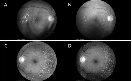 Figure 2 Vitreous haemorrhage and maculopathy in a 54- year- old man with type 1 diabetes are shown (A) before and (B) after three intravitreal bevacizumab injections.(C) Neovascularisation at disc and retina were rapidly inactivated (D) after a single intravitreal bevacizumab injection in a 28- year- old man with type 1 diabetes.