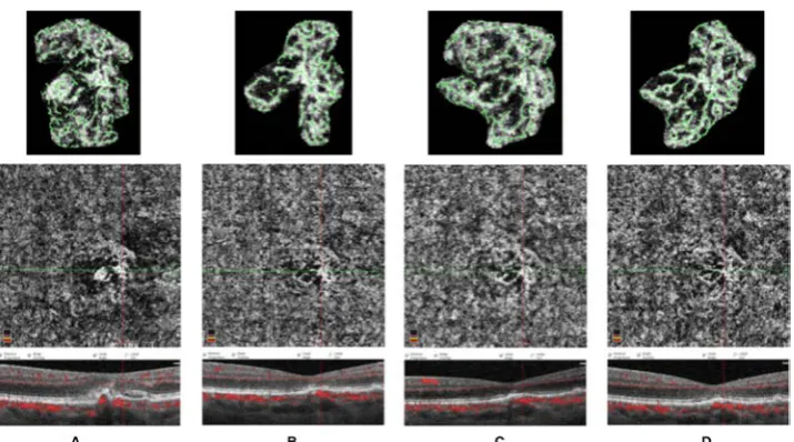 Figure 2 Type 1 CNV on OCT- A with corresponding B- scans and vascular diagrams at initial diagnosis (a), after anti- VEGF treatment in the inactive phase (b, d) and with renewed activity (c).