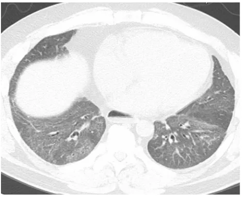 FIGURE 2. High-resolution computed tomography from a patient withsystemic sclerosis showing peripheral and basilar predominate reticulation andhoneycombing with an absence of significant ground-glass opacities in a patternconsistent with usual interstitial