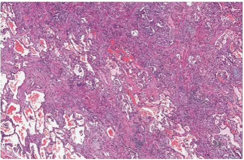 FIGURE 4. Histopathology results from a patient with systemic sclerosis andusual interstitial pneumonia showing patchy interstitial fibrosis in close proximity tounaffected lung tissue.