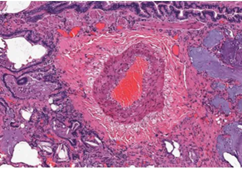 FIGURE 5. A pulmonary arteriole from a patient with systemic sclerosis-associated pulmonary artery hypertension showing significant medial hypertrophy.