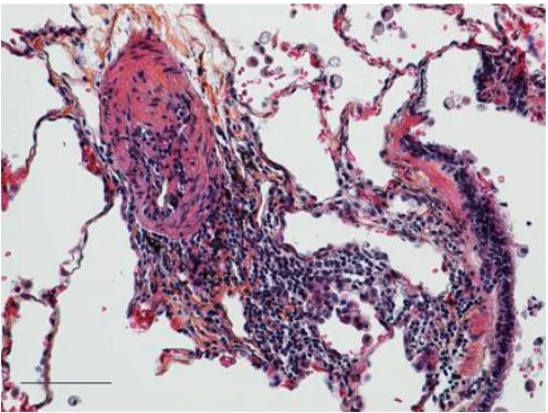 FIGURE 1. Elastic staining of paraffin-embedded lung tissue. A pulmonaryarterial lesion from a patient with idiopathic pulmonary arterial hypertension, illustratingthe perivascular lymphocytic infiltrate (centre), a small pulmonary artery (left) and abronc