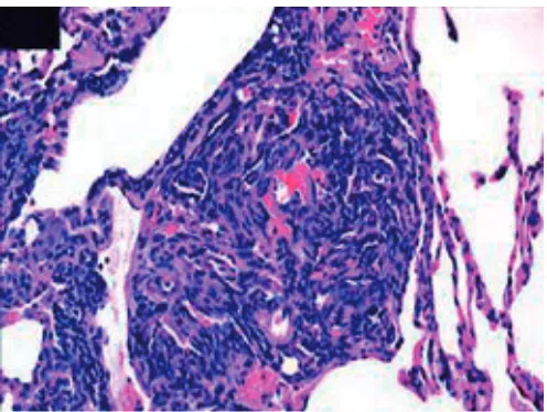 FIGURE 3. Plexiform lesion from a patient with severe pulmonary hypertensiondemonstrating the exuberant proliferation of cells that comprise the lumen of thesmall pulmonary artery