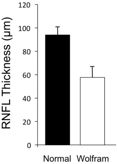 Figure 3 Retinal nerve fibre layer mean thickness for patients with WFS versus controls. WFS, Wolfram syndrome.