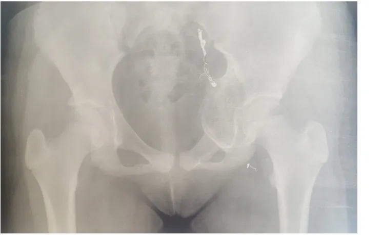Figure 2. Follow-up CT scan of the patient 2 years after the operation