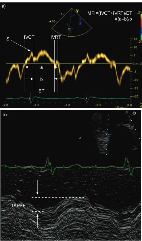 FIGURE 5. An algorithm for investigating pulmonary hypertension (PH) usingechocardiography
