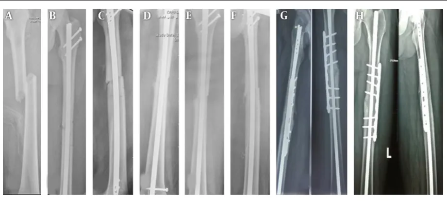 Figure 1. A , Femoral shaft fracture; B, Primary Intramedullary nailing; C and D, 6 months postoperative nonunion of femoral fracture; E and F, 9 months postoperativenonunion of femoral fracture; G, 4 months post- plate augmentation; H, 6 months post- plate augmentation