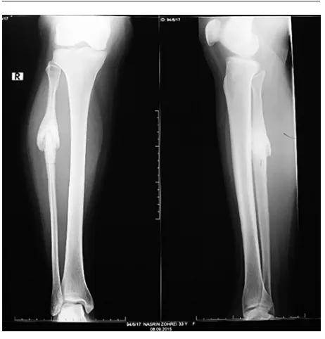 Figure 1. A nteroposterior and lateral radiographs of the leg show ly tic line in prox-imal ﬁbular diaphy sis and extensive periosteal new bone formation