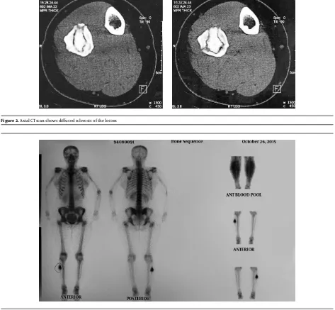 Figure 2. A xial CT scan shows diﬀused sclerosis of the lesion