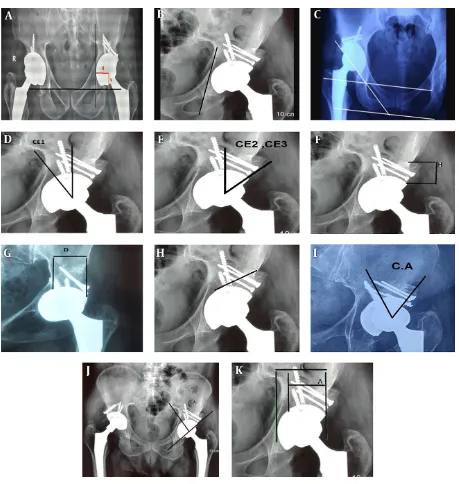 Figure 1. How the variables were measured. A , Determination of vertical (V) and horizontal (H) positions of the center of the hip; B, Cup distance to the Kohler line; C, Cupinclination angle and inter- teardrop and trans- ischial lines; D, Center- edge an