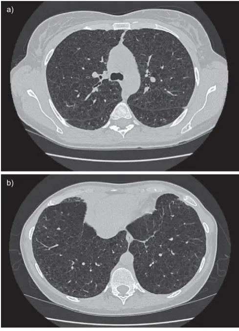 FIGURE 7. High-resolution computed tomography scans of the chest in apatient with histological diagnosis of lymphangioleiomyomatosis