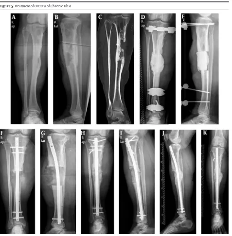 Figure 5. Treatment of Osteitis of Chronic Tibia