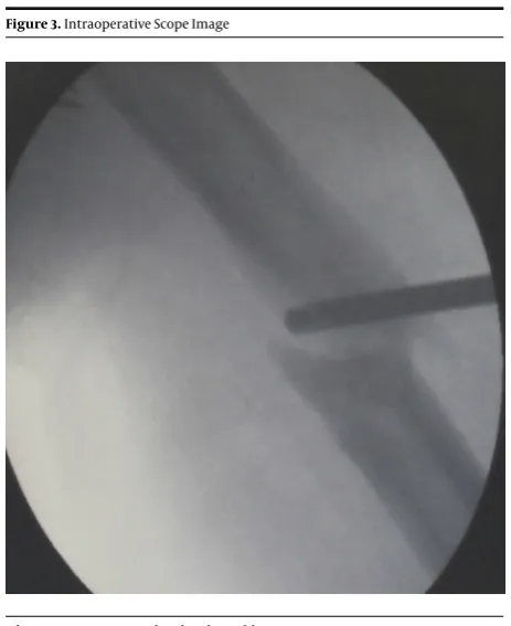 Figure 3. Intraoperative Scope Image