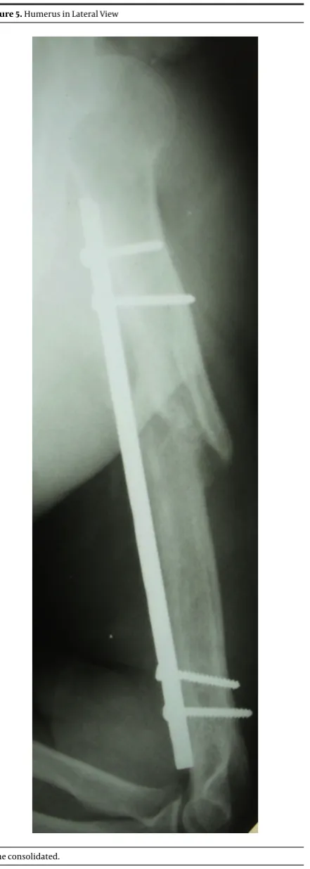 Figure 5. Humerus in Lateral View