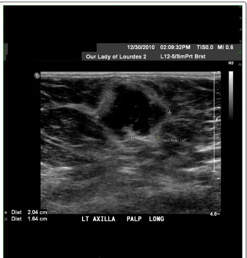 Figure 1 Ultrasound image of the irregular mass in the left axilla.