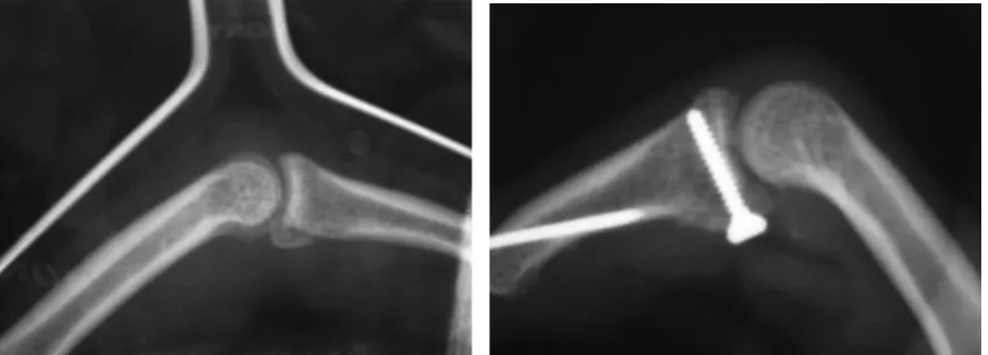 Fig. 1a. P2 volar base fracture dislocation with involvement of less than 30% of articular sur-face