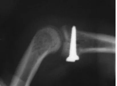 Fig 4c- The hemi- hamate auto graft is fixed by 2 mini screws. Note to the restored articular surface