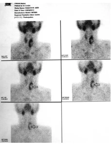 Figure 2Tc99m sestamibi scan did not reveal any functional parathyroid adenoma.