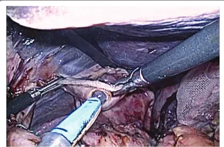 Figure 4 A tube was made to pass through from a small holeat the tip of the open end of the esophagus.