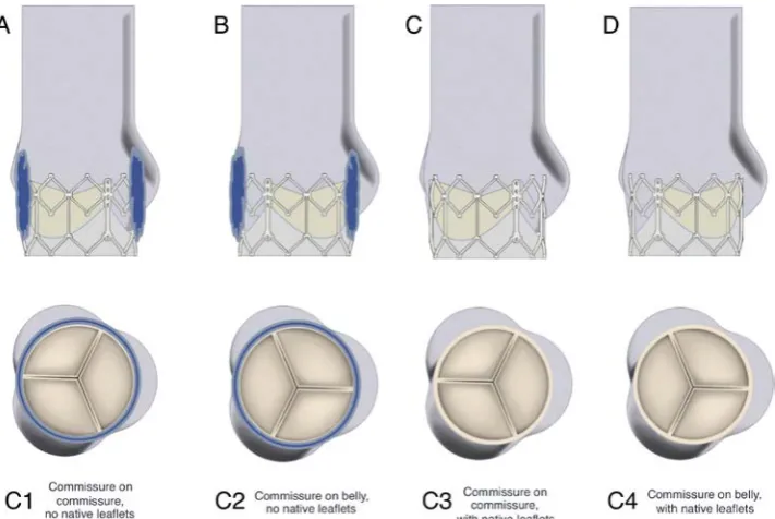 Figure 1 Valve- root configurations considered in study. (A) Configuration C1—commissures of TAV and aortic root model aligned, TAV placed within a cylinder to simulate native leaflets