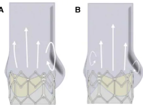 Figure 7 Vortical behaviour changes due to valve alignment. (A) Commissure to commissure alignment results in centre of moving leaflet and maximum sinus bulge being aligned, resulting in a single, larger vortex next to the sinus