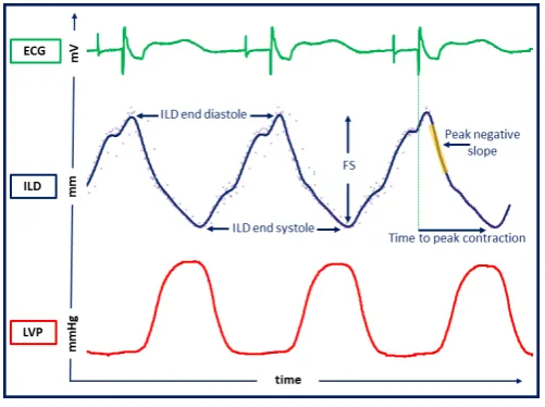 Figure 2 Patient example of the continuous RV–LV ILD waveform under BIVP displayed over time as a signal averaged flow curve