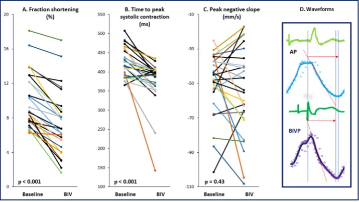 Figure 4 Baseline and BIVP values are presented for all patients with regard to three contractility surrogates (A, B and C) based on waveforms derived from the RV–LV interlead distance