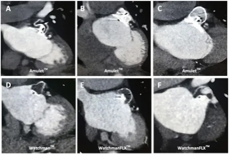Figure 1 Flow chart. Flow chart showing the number of patients with successful percutaneous LAA closure based on the evaluation of the 3-month CT follow-up. LAA, left atrial appendage; MSCT, multislice CT; TEE, transoesophageal echocardiography