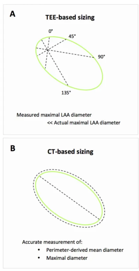 Figure 6 Challenges with 2D-TEE-based LAA sizing. (A) The disadvantage of 2D-TEE-guided sizing despite the use of multiple angles for assessment of maximal LAA diameter