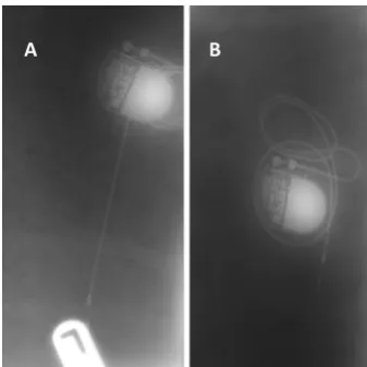 Figure 1 Radiographs of in situ pacemakers control (A) and antimicrobially processed surface (B).