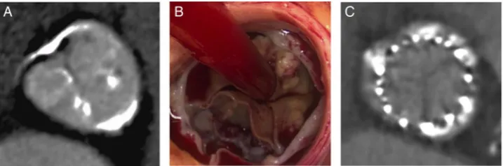 Figure 1Structural valve degeneration. (A and B) Bioprosthetic aortic valves calcify along the cusp commissures mimicking thepattern found in native aortic valve disease