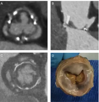Figure 2(A and B)Hypoattenuation leaflet thickeningsuggestive of thrombus formationon the supravalvular surfaceimpinging leaflet motion