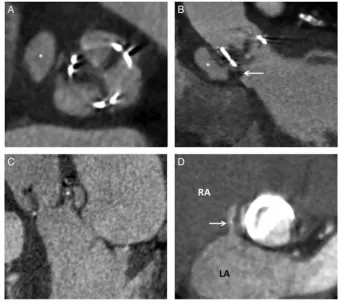 Table 1Differentiating pannus from thrombus on cardiacCT