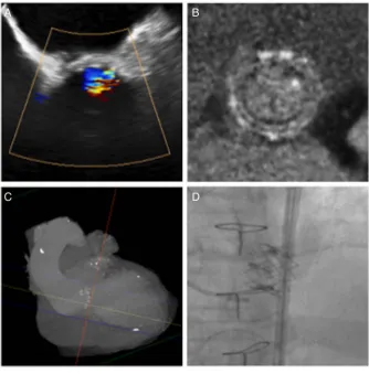 Figure 5An example adjunctiveCT imaging in the managementof aortic valve replacementdysfunction