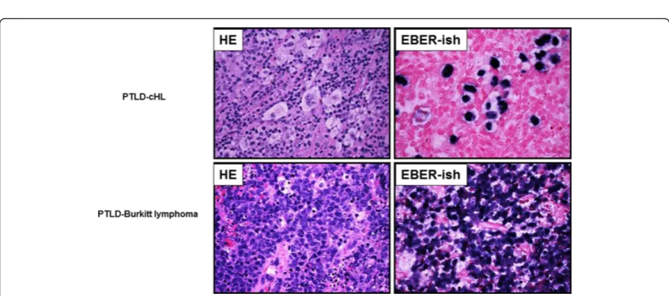 Figure 2 Representative cases EBV positive malignant lymphoma detected by LLMDA in FFPE tissues