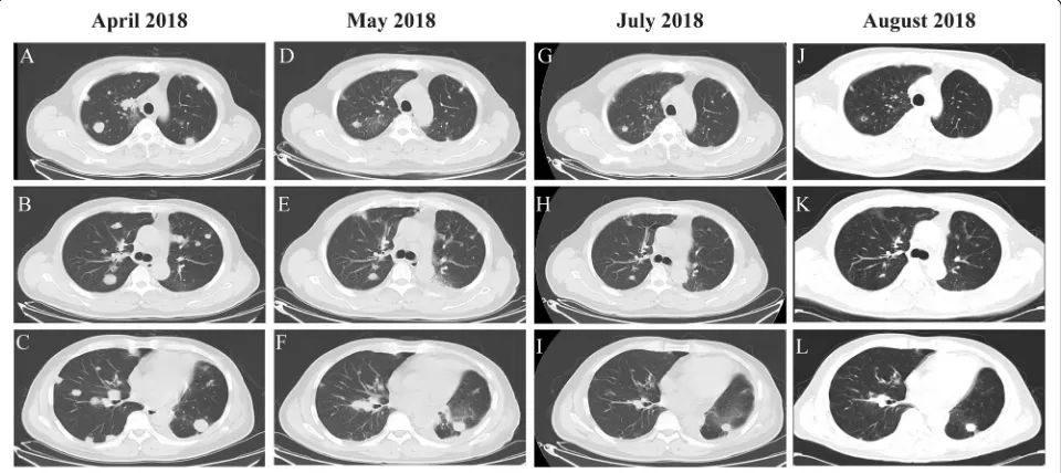 Fig. 4 Pathological examination of postoperative tumor tissue revealed of lung adenocarcinoma and immunostaining of PD-L1 (a) and MMR-related proteins, including MSH2 (b), MSH6 (c), MLH1 (d), and PMS2 (e) in postoperative tumor tissue