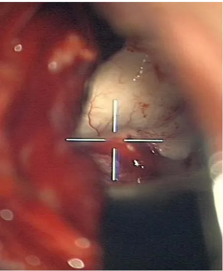 Figure 2. View of the hippocampus through the navigated microscope. 