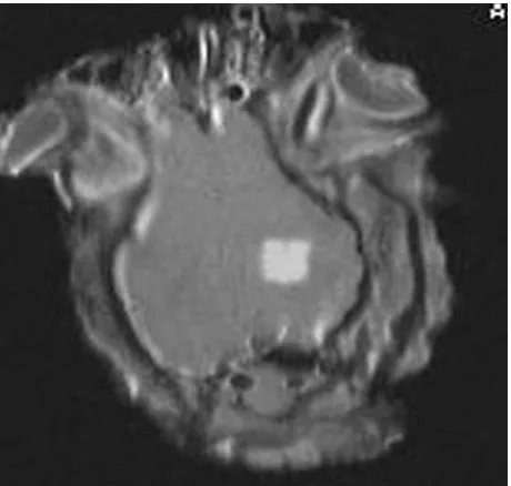 Figure 12. MRI image using T1-w FSE of large thermal lesion created in vivo using 2000 W/cm2 for 20 s