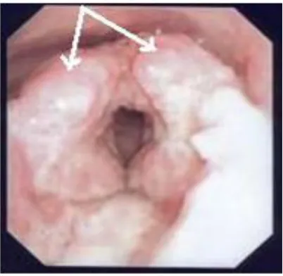 Figure 2. Pathology slide: Tonsillar tissue with huge gigantocellular gra-nuloma and caseous necrosis