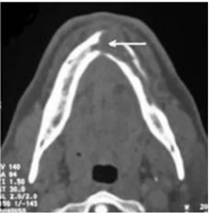 Figure 4. Mandible CT scan: An osteolytic process of the left hemi-mandible extending to the symphysis, breaking the cortex by places, with a tissue matrix density and measuring 3 × 5 × 1.5 cm