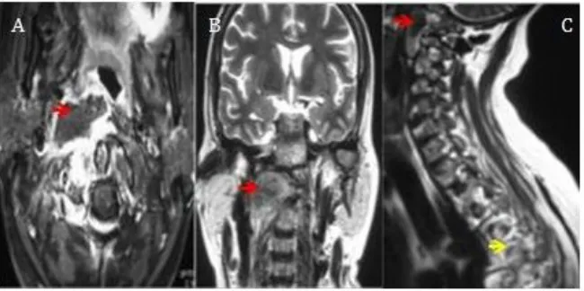 Figure 5. MRI of cervical and dorsal spine showing soft tissue mass developed ahead of on T2 weighted images with peripheral enhancement