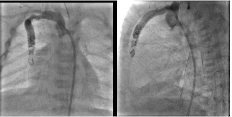 Figure 4. Aortic angiogram in LAO 15/Cr 20 and lateral pro- feeding the arterio-venous malformation (AVM) to the right lobe of the liver.jections showing dilated and tortuous internal mammary artery,  