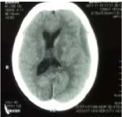Figure 3. Intra operative picture after small wound closure.   