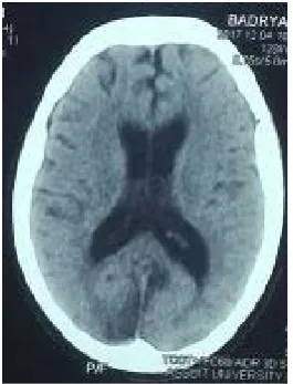 Figure 5. Showing complete evacuation of the left frontoparieal CSDH after using double twist drill craniostomy