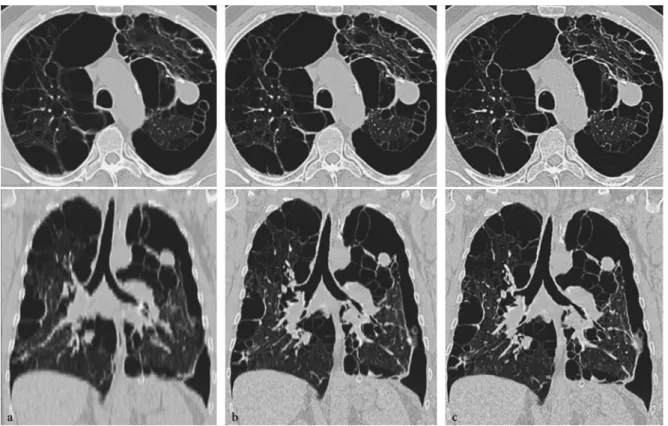 Fig. 3.2a–c. Case study consisting of axial slices and coronal multi-planar reformations (MPRs) of a thorax examination illus- illus-trating the clinical performance of a single-slice CT (7-mm slices, 30 s), b 4-slice CT (1.25-mm slices, 30 s) and c 16-sli